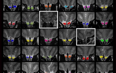 An Exception to the Rule: An Intact Sense of Smell without a Crucial Olfactory Brain Structure